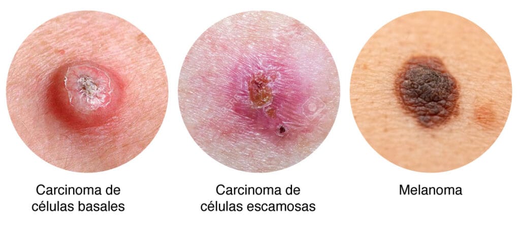 img-uv-tipo-cancer