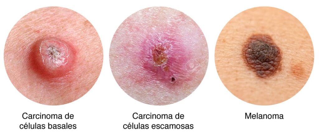 img-uv-tipo-cancer